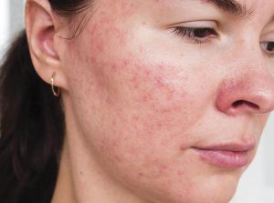 s2-300x223 BROCHAS Y ESPONJAS DE MAQUILLAJE: UN FOCO DE INFECCIONES